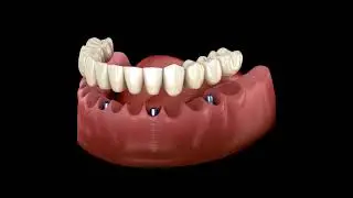 Full Arch Rehabilitation on Implants - Animation