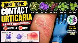 DABT Topic_Contact Urticaria