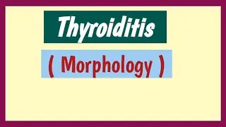 Hashimotos Thyroiditis and Subacute Granulomatous Thyroiditis Pathology - ( Morphology )