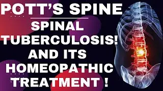 POTTS  DISEASE || POTTS SPINE || SPINAL TUBERCULOSIS || BEST HOMEOPATHIC MEDICINE FOR POTTS DISEASE