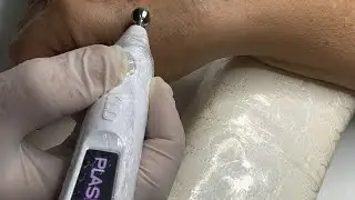 Caneta plasmax kld, protocolo de permeação de ativos e remoção de senis