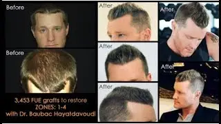 Natural Hair Transplant and Density in Los Angeles – Dr. Baubac Hayatdavoudi | AlviArmani
