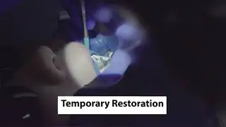 How to Use Coltene DuoTemp Temporary Restoration Dentbear.com