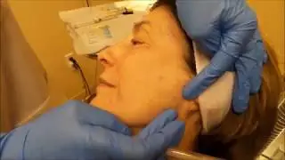 BellaFill Filler Treatment with Dr. Kristen Richards At Torrey Pines Dermatology
