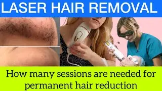 Does laser hair removal work permanently? Laser hair removal honest  Review 💯 |Dr.HS