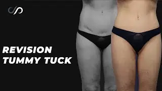 Top Plastic Surgeon Reveals BEST Tummy Tuck Revision Techniques