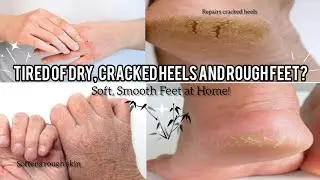 Best DIY Cream for Cracked Heels & Rough hands| Soft, Smooth at Home!