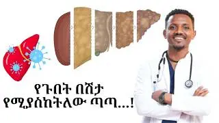 የጉበት ጉዳትን የሚያስከትሉ ነገሮች# የጉበት ስብ #Fatty Liver disease#What damaged the Liver | Dr.Kebede | ዶ/ር ከበደ