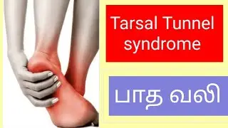 பாத வலி.Tarsal tunnel syndrome