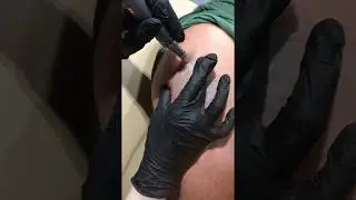 MicroNeedling for Tattoo Removal In Portland Oregon?