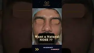 Nose Perfection only at #drmonishakapooraesthetics #shorts #trending
