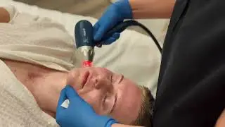 PiXel8-RF (Radiofrequency Microneedling) Treatment in Action at Ria Skin Care and Spa