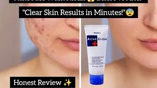 Clear Skin in Days | Mistine Acne Clear Facial Foam Honest Review✨