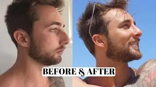 Male Before & After Rhinoplasty, Nose Job 12 weeks post Operation, 12 weeks after