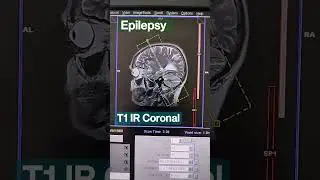 Brain epilepsy protocol planning perpendicular to hippocampus