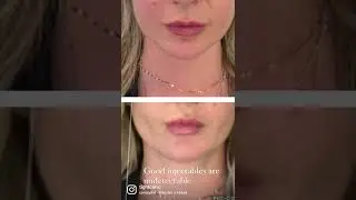 Demonstrating 1 Syringe of Chin and Pre-Jowl Filler