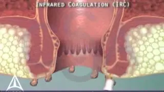 Anal warts & infrared coagulation treatment - 3D animation