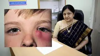 Eye Diseases in Children