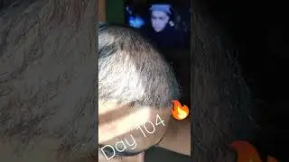 104 Days SUN LIGHT🔥HSN HAIR TRANSPLANT#tamilanht #fue#prp#hairtransplantation#viral#shorts#prp#gfc