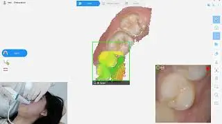 MY-D072D Intraoral Scanner - High-Precision 3D Oral Scanning for Improved Dental Care