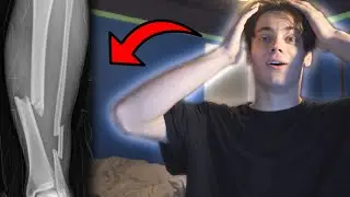 Watching my fail *BROKEN BONE* injuries, flips and where I'm at