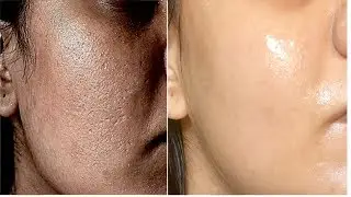 How to get rid of Large OPEN PORES permanently