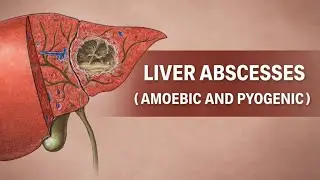 LIVER ABSCESSES | AMOEBIC AND PYOGENIC  | CLINICAL FEATURES DIFFERENTIATION INVESTIGATION MANAGEMENT