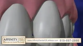 Dental Implants Affinity Dental of La Mesa