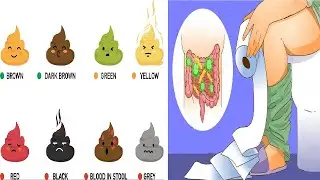 Stools colors , When to worry , What poops colors mean and show about your health ?
