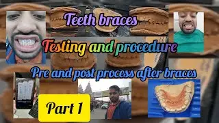 Journey of Teeth braceing #smile #selflove #happymoments #patna (part 1)
