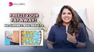 Fat Freezing Explained by Dermatologist | Freeze Stubborn Fat Without Surgery | Soul Derma Clinic