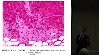 Myositis and Heart Disease, Dr. Christina Charles-Schoeman 2017 Annual Patient Conference