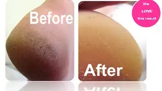 Best Pedicure - How to get rid of cracked heels with MediHeel