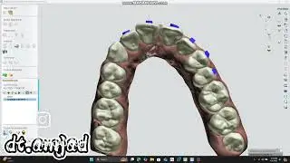 #surgicalguide #ortho #invisalign #b4d #implant #teeth #veneer #exocad #dentist  #dubai🇦🇪 #اكسبلور