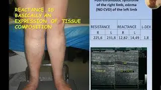 Bioimpedance spectroscopy in lymphedema - Dr Attilio Cavezzi