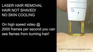 Here is why you need to shave before Laser Hair Removal