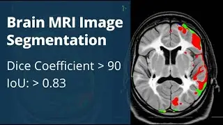 Brain MRI Segmentation Using U-Net | Data Augmentation | CNN | Deep Learning | AI in Healthcare