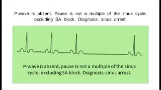 13 Sinus Node Dysfunction