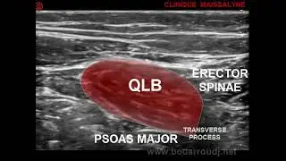 ULTRASOUND QLB BLOCK TYPE 3 TRANS MUSCULAR