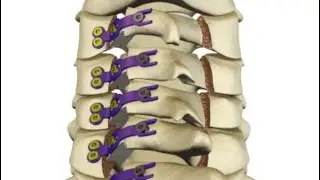 Spinal surgery . (Cervical Laminoplasty & disc replacement C4-C7) 28th October 2025. #spinehealth 