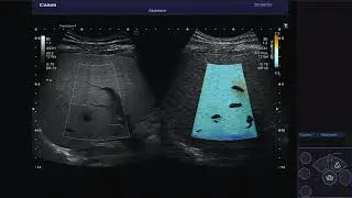 ATI Liver Steatosis - Canon Medical Systems