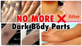 *Eid Special* Bye-Bye Dark Body parts | How to lighten dark body parts