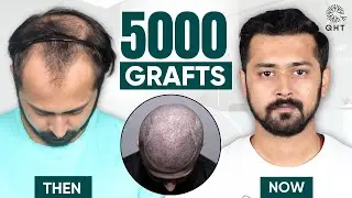 Hair Transplant in Delhi | Best Hair Transplant in India | QHT Clinic