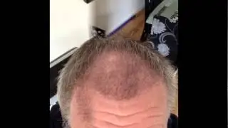 2000 FUE Before & After 22 Weeks Transplant Patient Diary | UK Hair Transplant Clinics