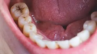 Why Your Teeth are Decaying Even If You Brush Every Day(live)