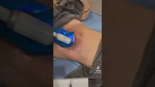 Cryo Slimming &Toning Treatment for fat loss without the downtime of liposuction