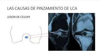 Causas de pinzamiento de injerto de LCA