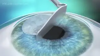 PRK vs. LASIK- What's the Difference?