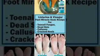 Beauty | Listerine & Vinegar for Extreme Foot Care