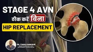 Stage 4 AVN: क्या बिना Hip replacement के ठीक होगा? | No Hip Replacement for Stage 4 AVN? #avn #hip